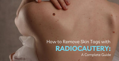 How to Remove Skin Tags with Radiocautery: A Complete Guide